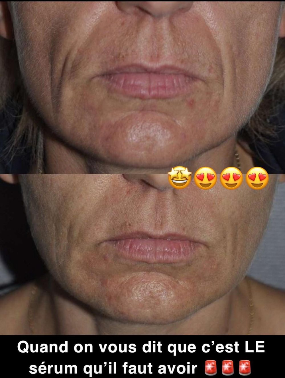 Le bas du visage, avant en haut et après en bas